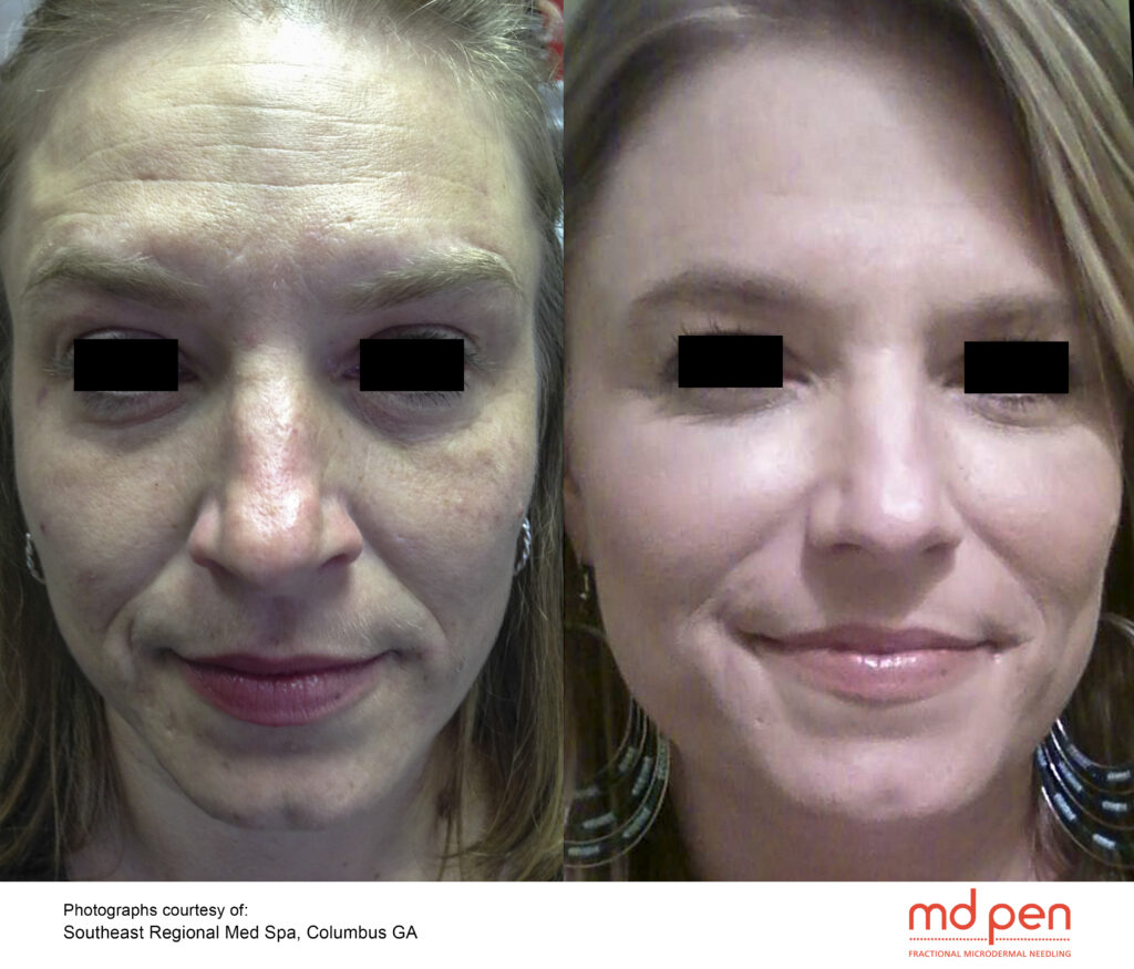 Microneedling MDPen before after Evansville Facial Plastic Surgery