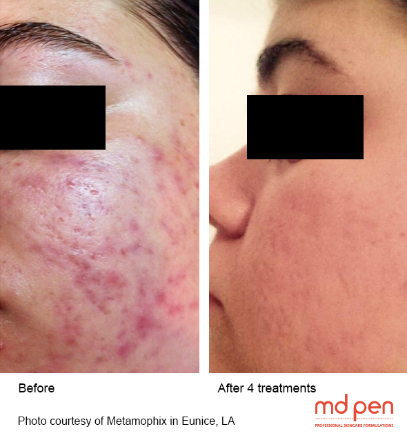 Microneedling MDPen beforeafter Evansville Facial Plastic Surgery