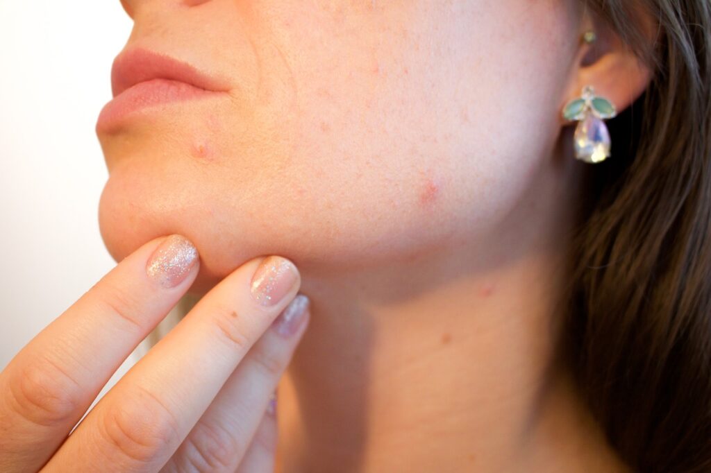 midwest facial plastic surgery mfps dr young paik blog understanding acne as an adult