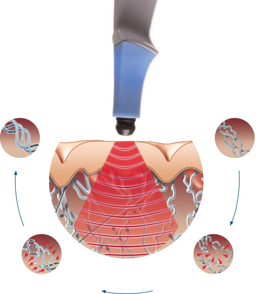 midwest facial plastic surgery mfps exilis 1